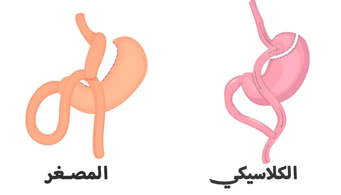 الفرق بين تحويل المسار المصغر والكلاسيكي: دليل اختيار الأفضل